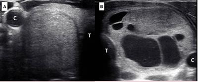 Improved cancer risk stratification of isoechoic thyroid nodules to reduce unnecessary biopsies using quantitative ultrasound